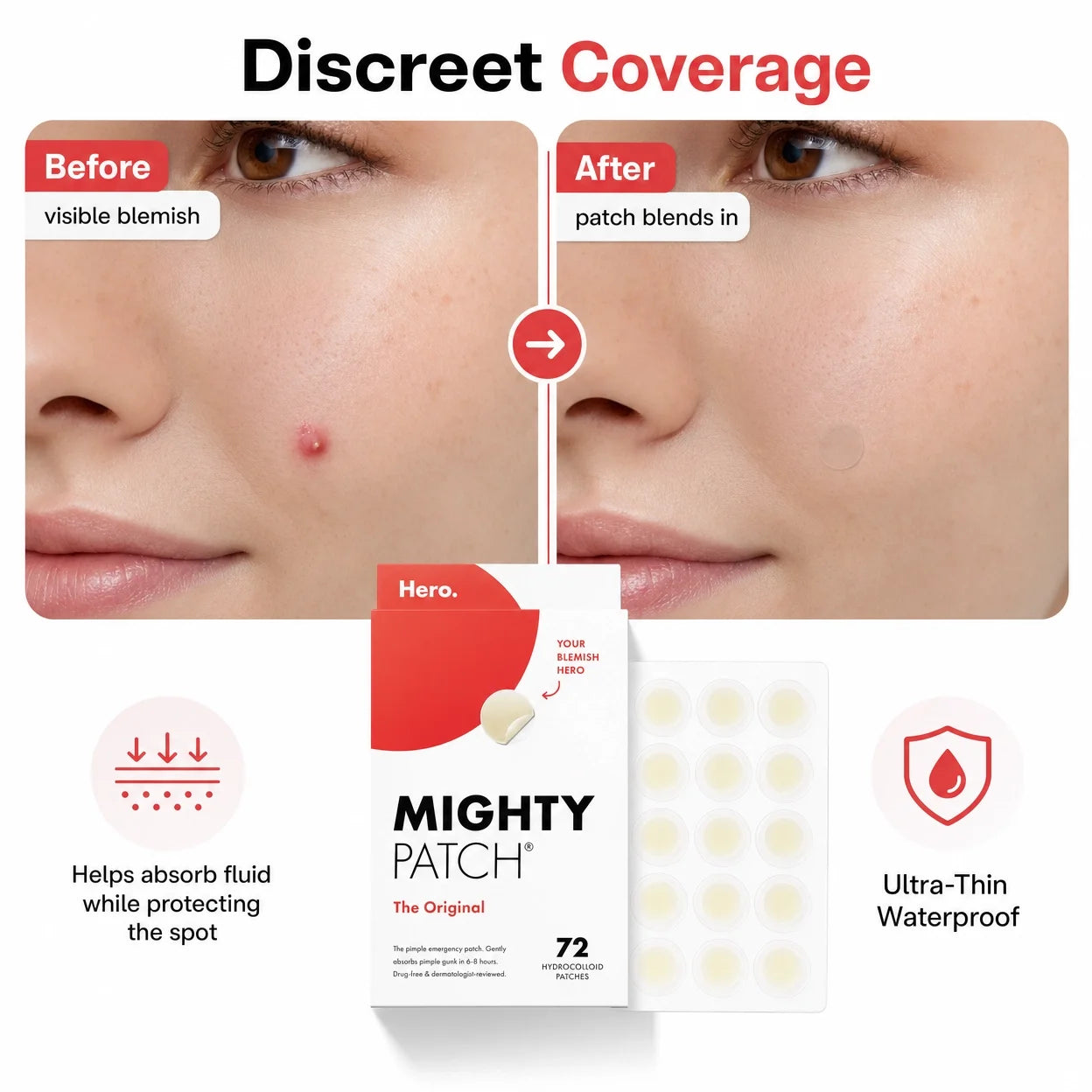 Hydrocolloid Acne Pimple Patches – Invisible Spot Treatment for Face